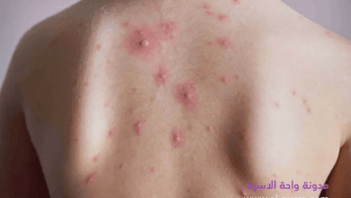 الجديري المائي عند الاطفال ...اسبابه واعراضه وعلاجه