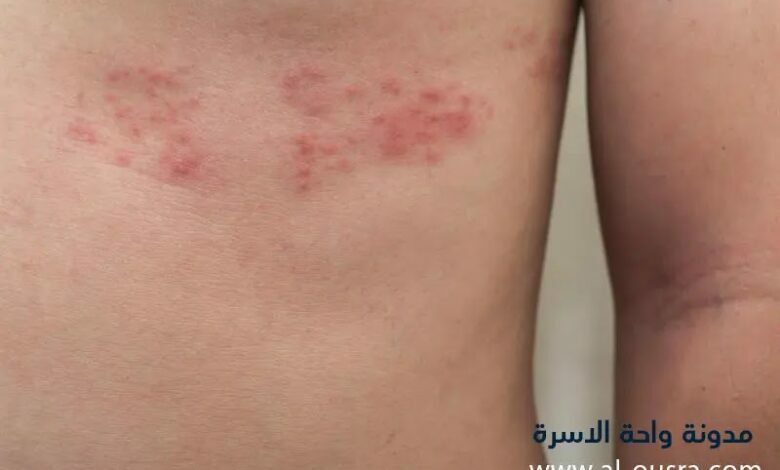 اسبابه ، اعراضه وطريقة علاجه بالتفصيل